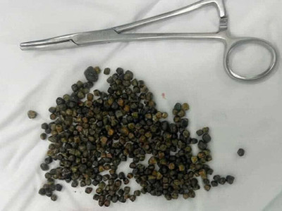 MỔ Ở MỸ THẤT BẠI, NỮ VIỆT KIỀU VỀ TP.HCM ĐƯỢC CÁC BÁC SĨ PHẪU THUẬT LẤY 481 VIÊN SỎI MẬT.