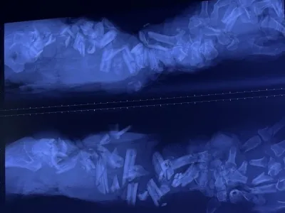 Người đàn ông nhập viện với cánh tay dập nát, xương gãy trăm mảnh